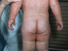 Measles: More Than Just  a Rash